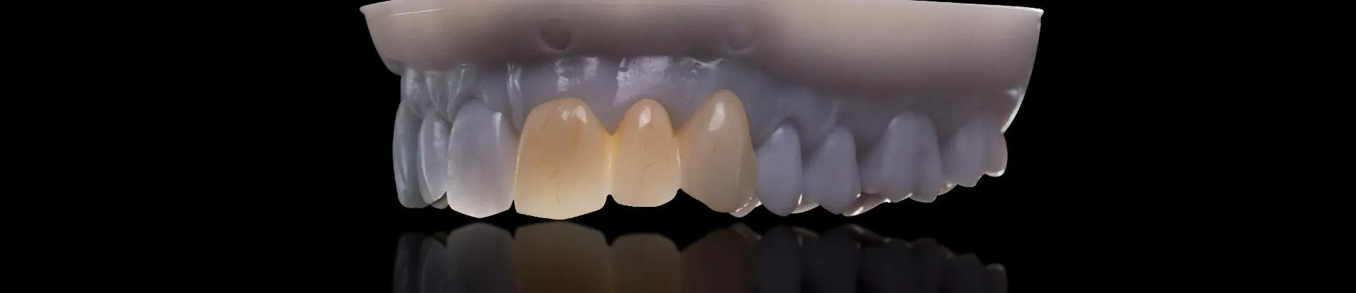 HUGE Digital Crown and Bridge Restoration